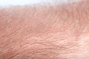 News Picture: Hairless Man Now Hairy, Thanks to Arthritis Drug