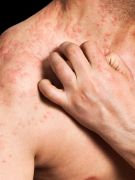 News Picture: New Eczema Drug Shows Promise in Early Trials
