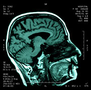 News Picture: Not Everyone With Alzheimer's-Linked Protein Develops Dementia: Study