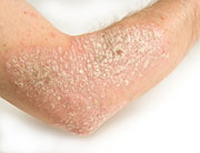 News Picture: Psoriasis Treatment Choices Improving, FDA Says