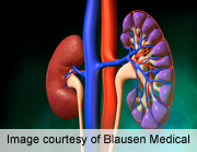 News Picture: Drug Combo Helps Lupus-Related Kidney Condition