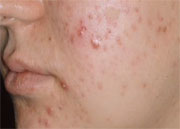 News Picture: Laser Used to Remove Tattoos May Help Reduce Acne Scars