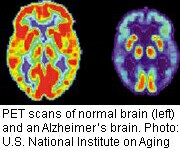 News Picture: Is Tau the 'How' Behind Alzheimer's?