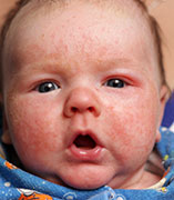 News Picture: Eczema Cases Rising Among U.S. Children: Report