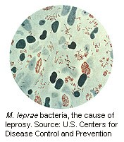 News Picture: Leprosy Still Occurs in U.S., CDC Reports